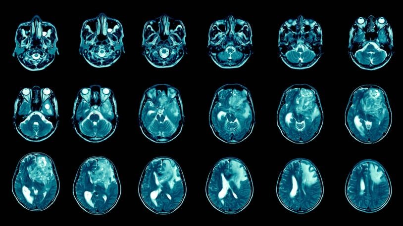 Image of glioblastoma patient brain MRI
